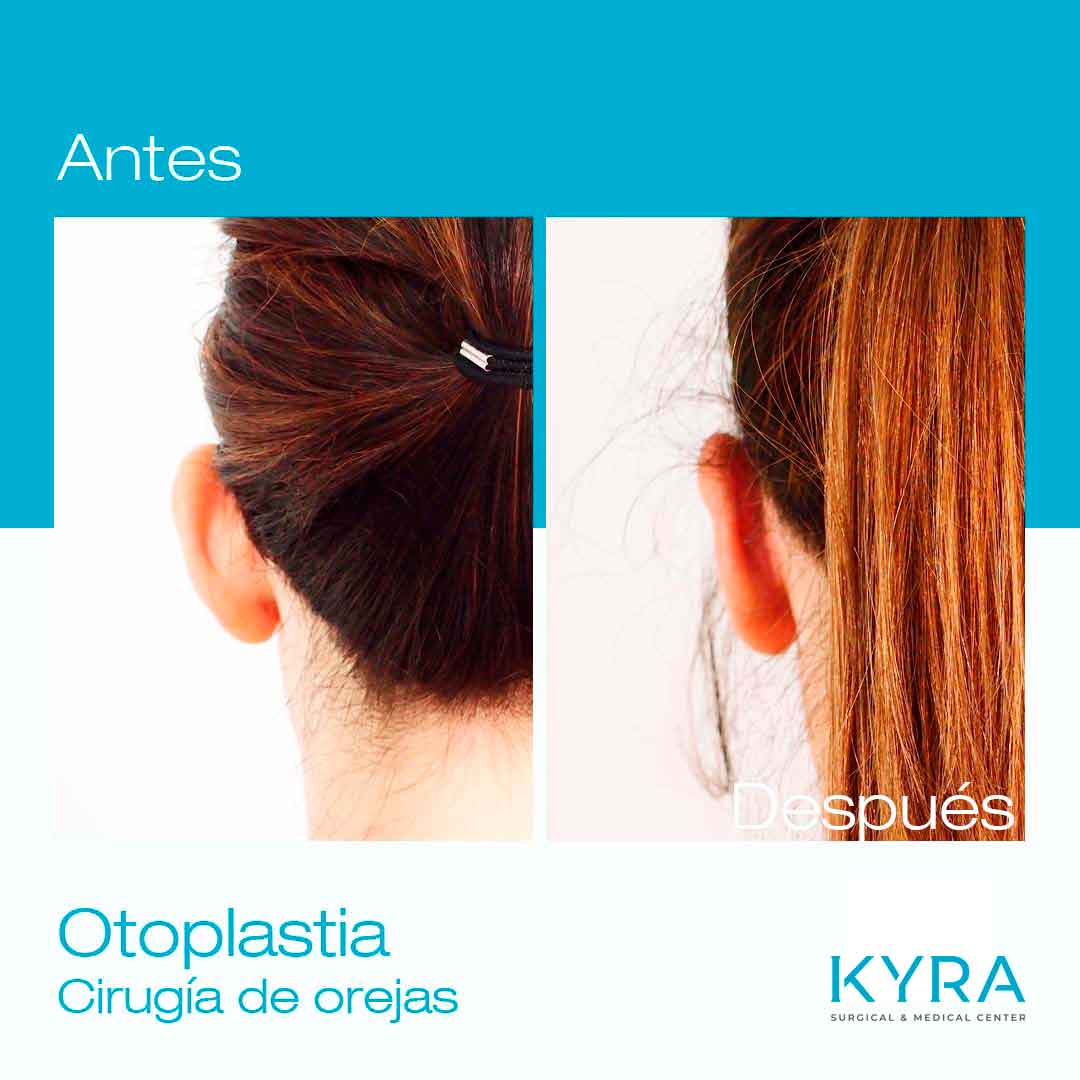 Otoplastia cirugía de orejas de soplillo en Alicante Kyra