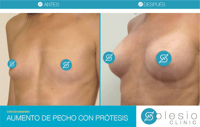 antes y despues cirugía aumento de pecho con prótesis
