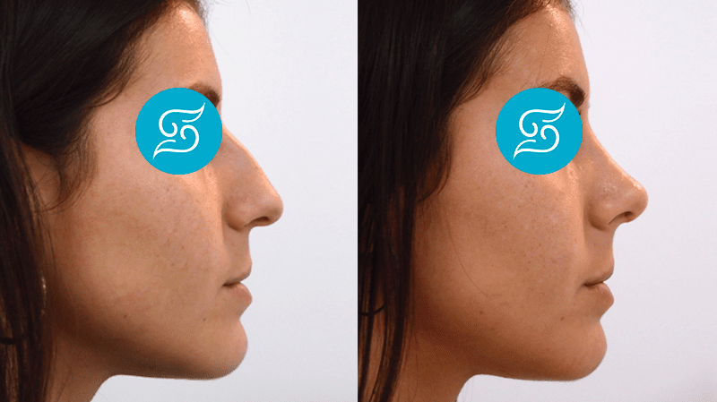 Antes y Despues de la Rinoplastia Ultrasónica en Alicante con el Doctor Francisco Solesio