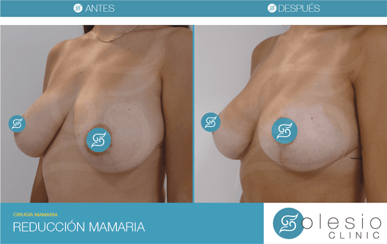 Reducción de mamas en clínica Kyra antes y después Dr Solesio