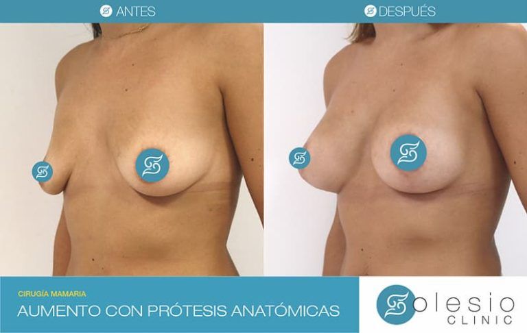 Antes Y Despues Aumento Con Protesis Anatomicas Motiva Alicante