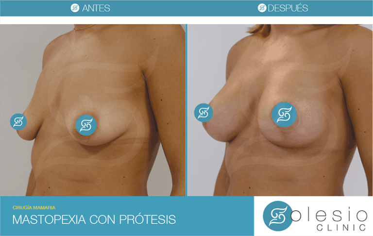 Mastopexia con protesis en Alicante antes y despues