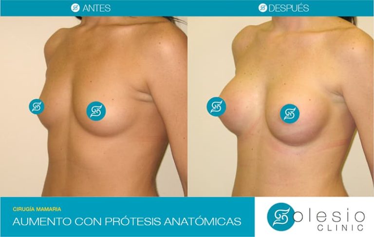 Aumento de Pecho con Prótesis Anatómicas en Alicante Antes y Después