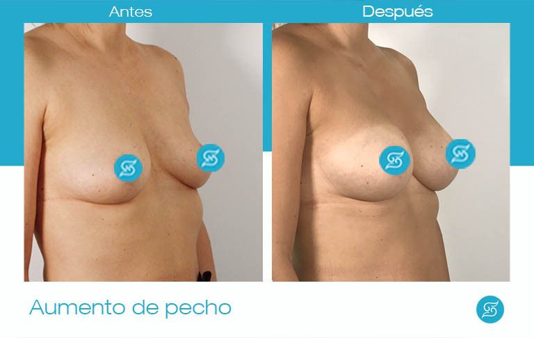 Aumento de pecho con prótesis anatómicas Alicante