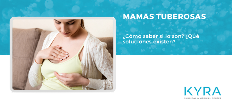 Mamas tuberosas Alicante
