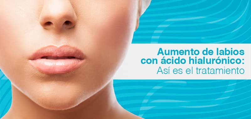 Aumento de labios con acido hialurónico en clínica Kyra Alicante