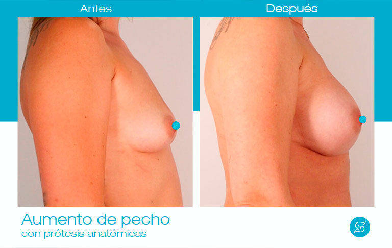 resultado perfil antes y después aumento de pecho anatómicas