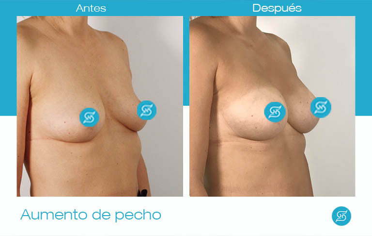 aumento de pecho prótesis anatómicas Alicante antes y después Dr Solesio 45 grados