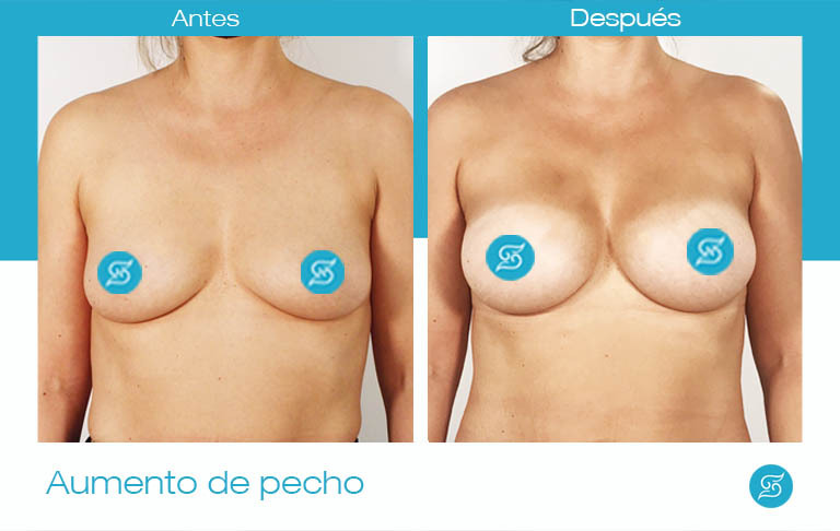 aumento de pecho prótesis anatómicas Alicante antes y después Dr Solesio frente