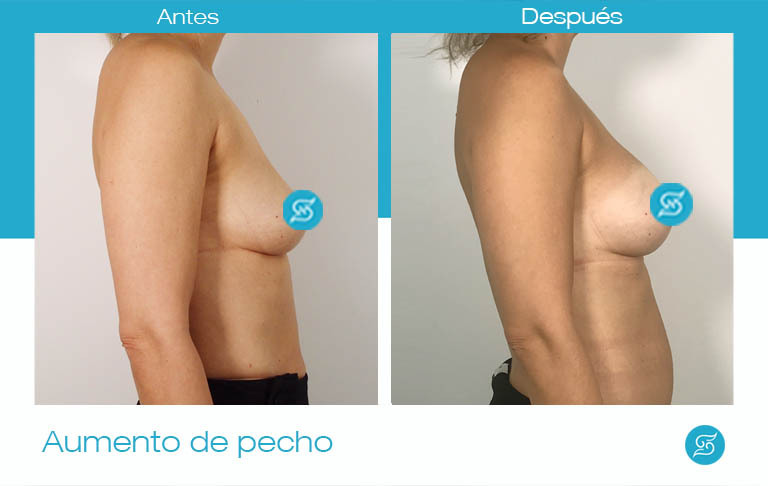 antes y después Pechos operados clínica Kyra Alicante