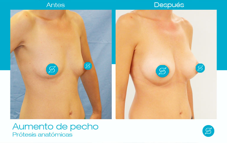 resultados aumento de pecho con implantes mamarios anatómicos