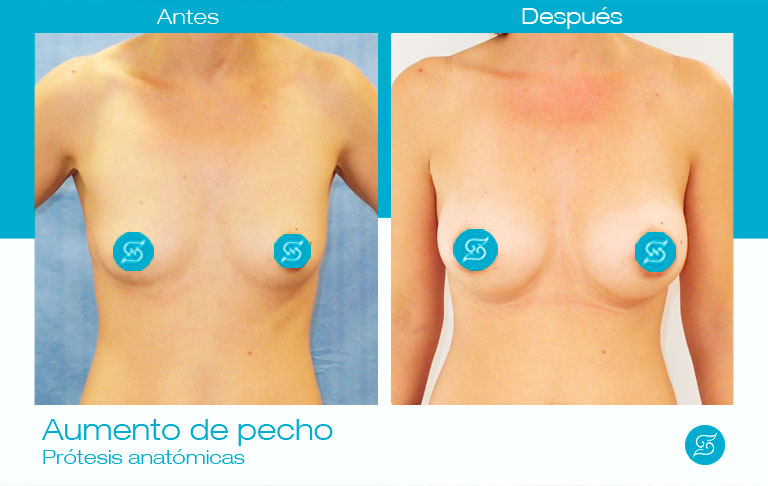 resultados aumento de pecho con implantes mamarios anatómicos Dr Solesio