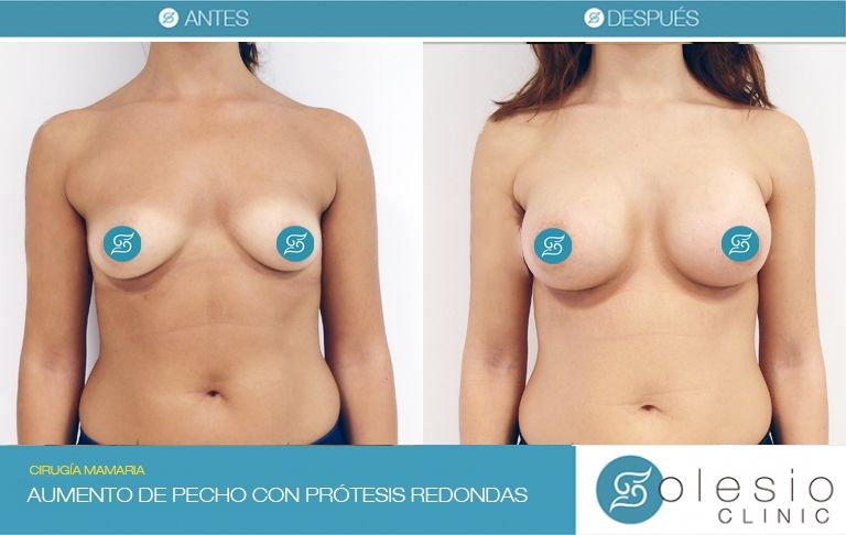 aumento de pecho Doctor Solesio Alicante antes y después