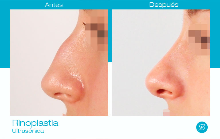 cirugía nariz alicante antes y después Dr. Solesio