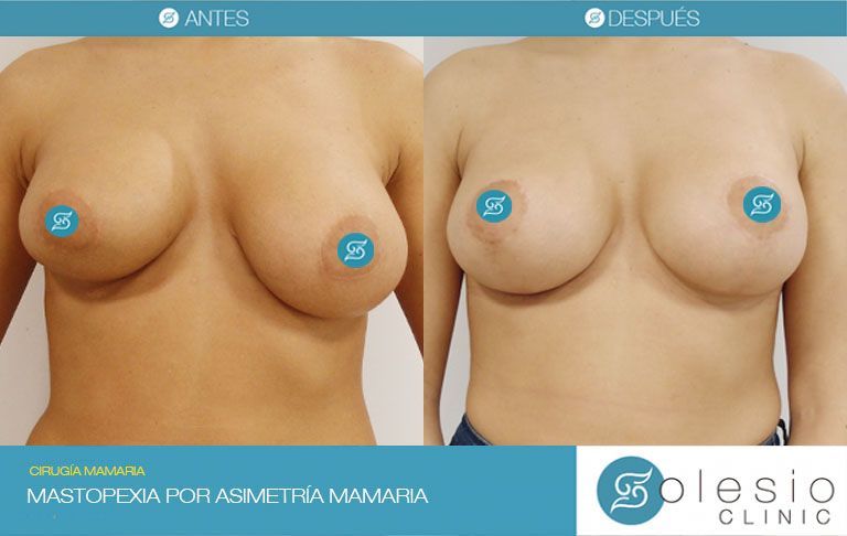 mastopexia asimetria mamaria cirugia mamaria doctor solesio alicante