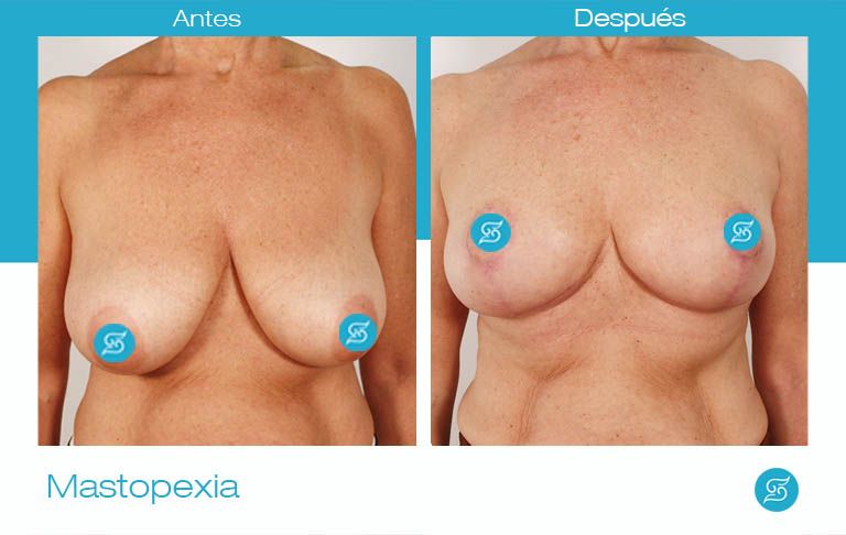 mastopexia cirugia mamaria alicante frente