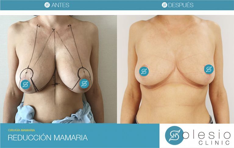 reduccion pecho cirugia mamaria alicante