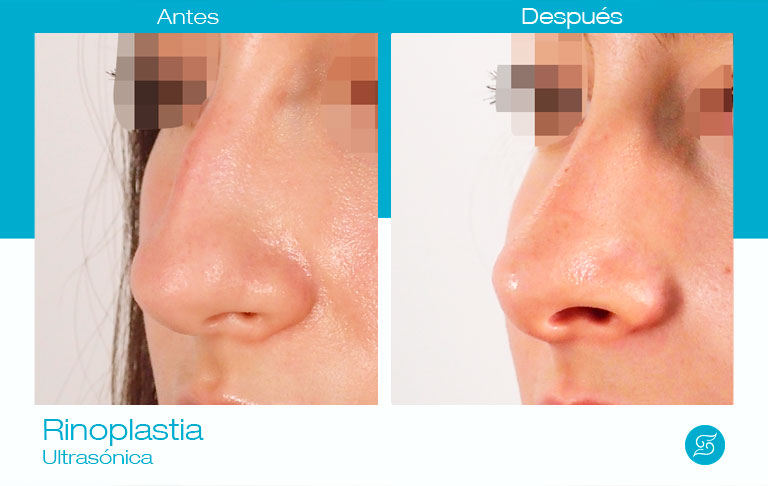 rinoplastia alicante antes y después dr Solesio cirugia nariz